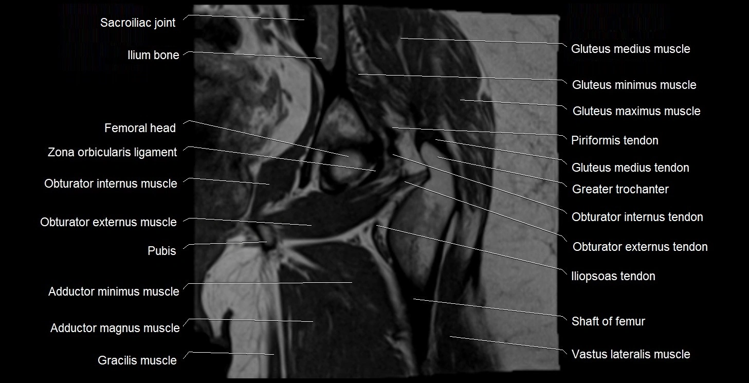 MRI Hip 3T coronal cross sectional anatomy image 39.webp